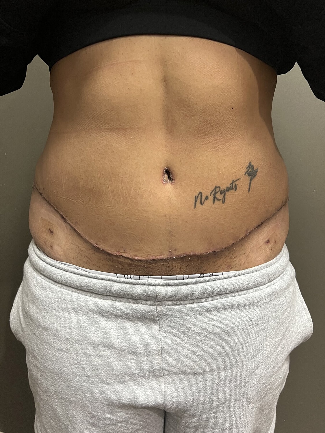 Abdominal scar with tattoo, showing healing skin.