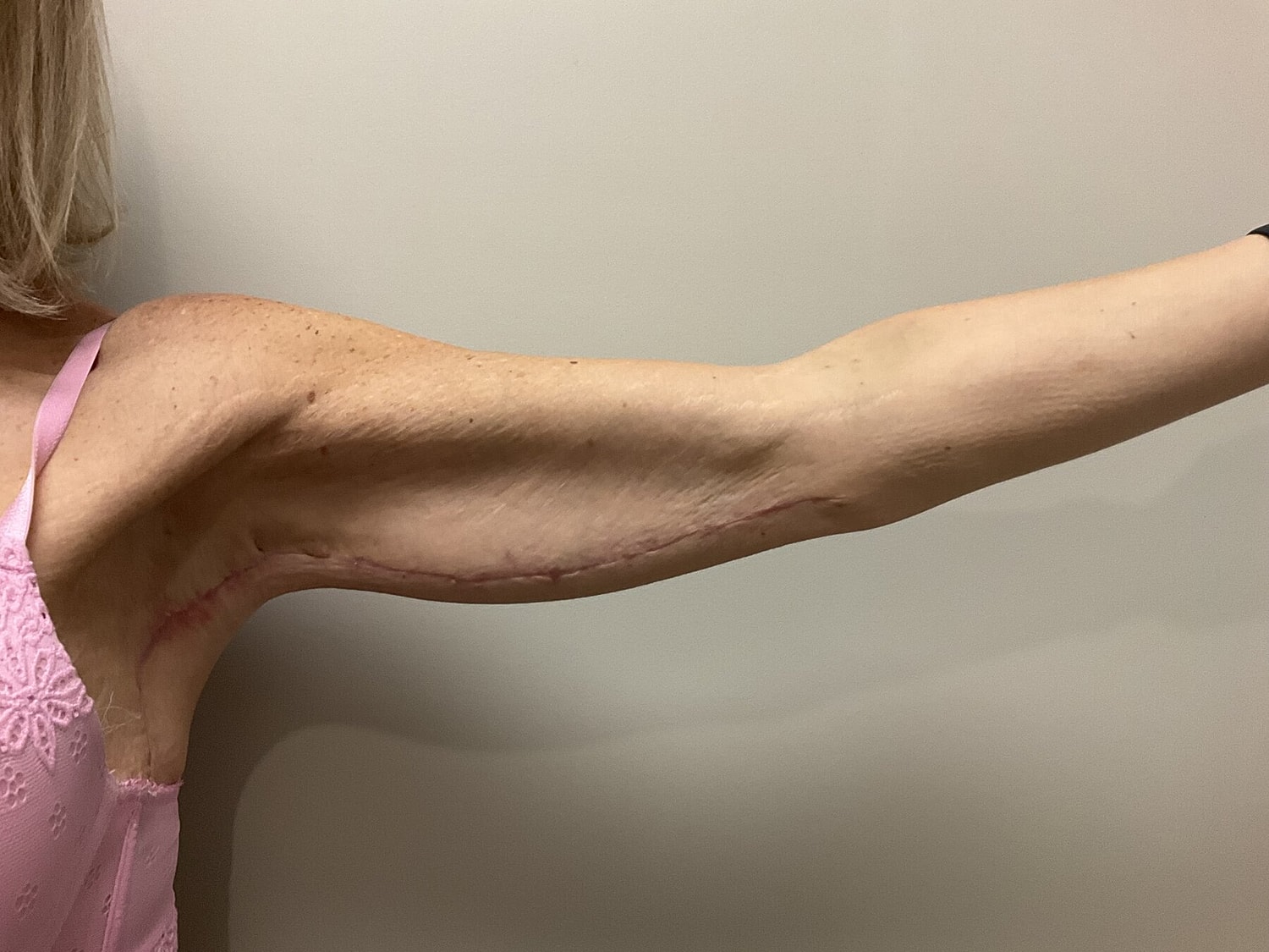 Woman’s arm showing surgical scars and skin texture.