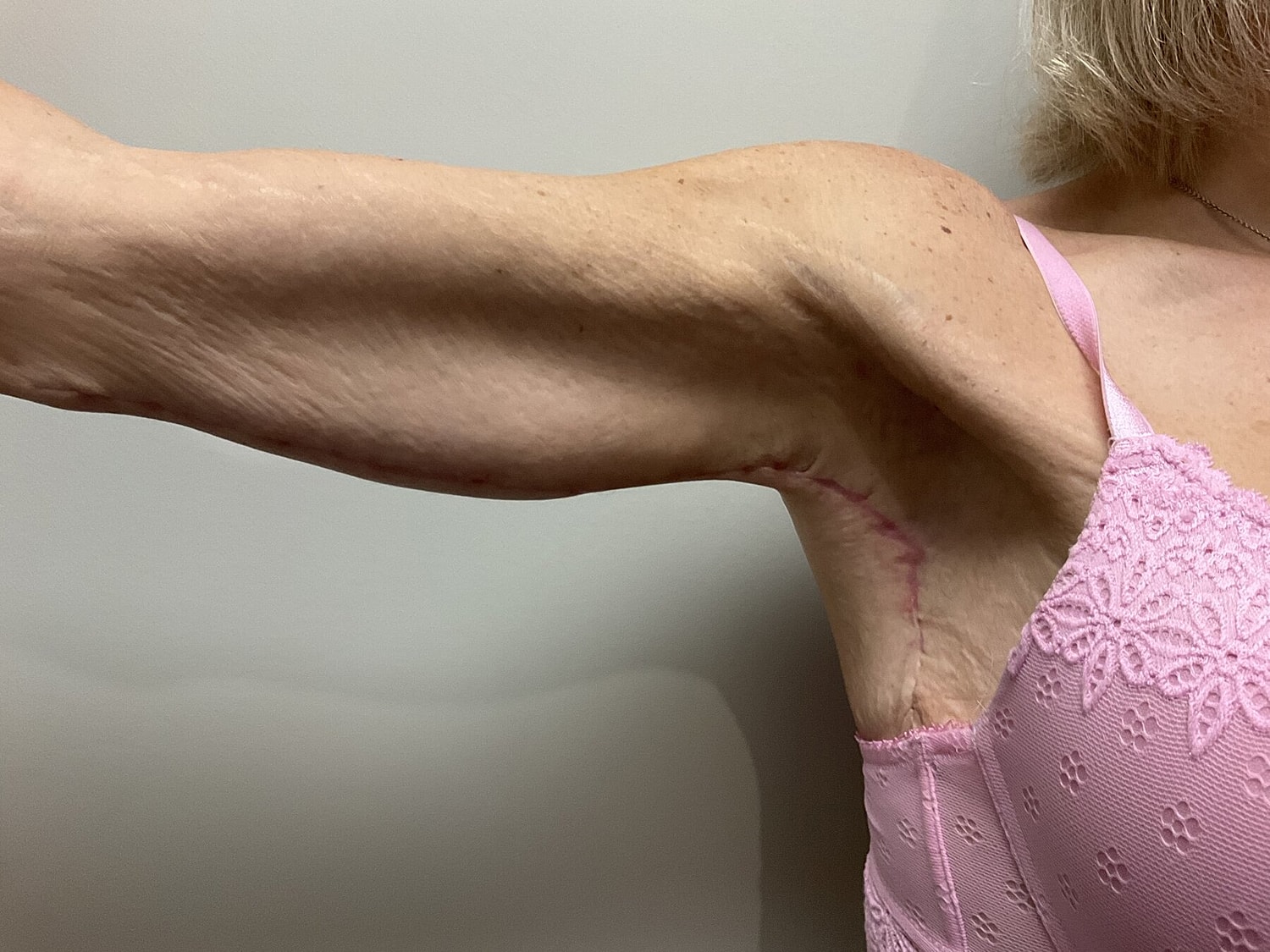 Arm with surgical scar wearing pink lingerie.