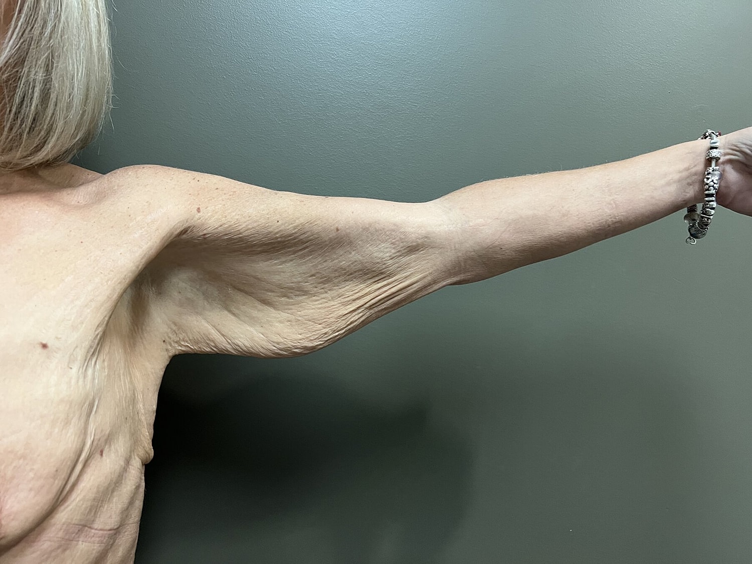 Close-up of a woman's arm and shoulder.