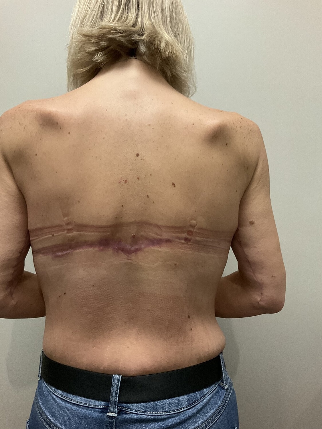 Surgical scars on a person's back.